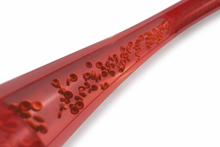 Hemolytická anémie u dětí