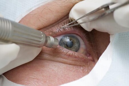 Katarakta neboli šedý zákal