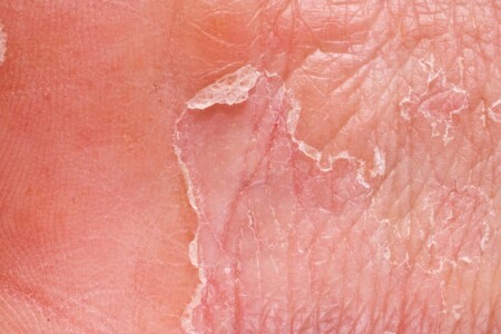 Dermatomyozitida u dětí