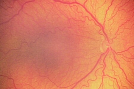 Retinopatie nedonošených