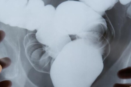 Ulcerózní kolitida