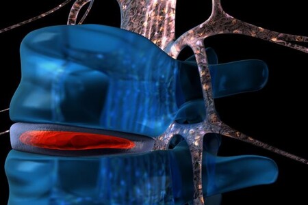 Výhřez meziobratlové ploténky