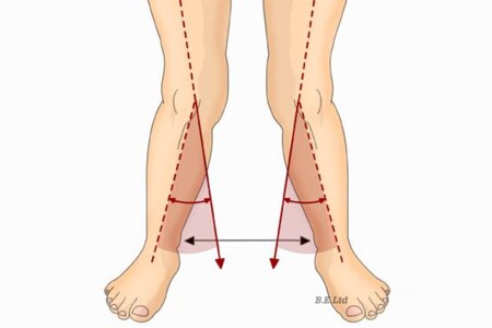 Vbočená kolena u dětí