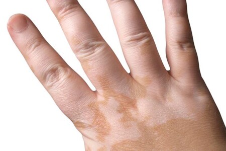 Vitiligo