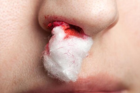 Krvácení z nosu