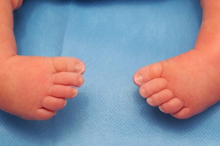 Koňská noha (pes equinovarus)